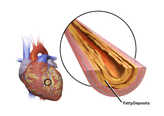 Coronary Artery Disease